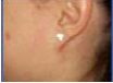 attached ear lobe - the end of the ear lobe is attached to the side of the face